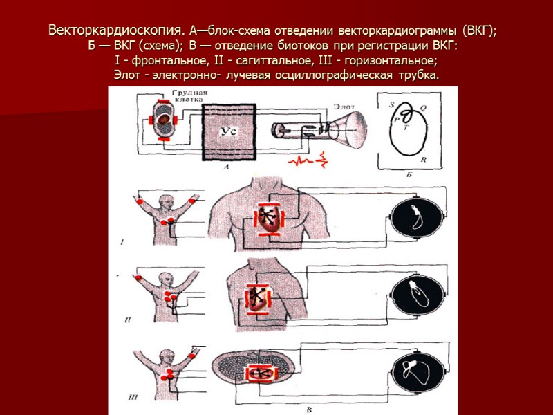 Векторкардиоскопия. А—блок-схема отведении векторкардиограммы (ВКГ);   Б — ВКГ (схема); В — отведение